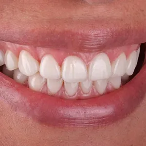 Before and after images of ruined teeth. These images show a result of the work of the dentist.