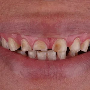 Before and after images of ruined teeth. These images show a result of the work of the dentist.