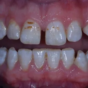 Before and after images of ruined teeth. These images show a result of the work of the dentist.